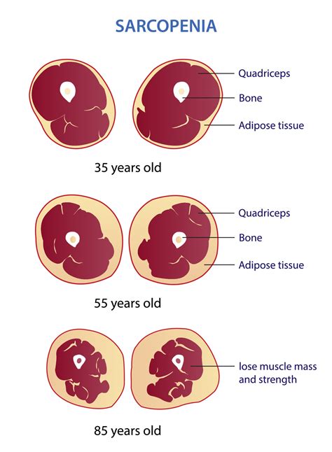 Infografía: Cambios en el cuerpo con la edad (sarcopenia, osteoporosis, artritis)