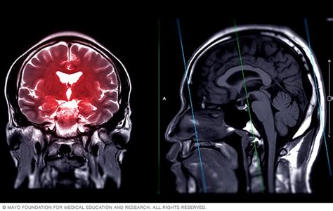 Resonancia magnética cerebral mostrando áreas vinculadas al TDAH