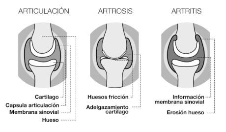 Ilustración esquemática de una articulación sana y una afectada por artrosis