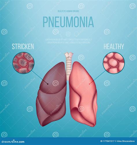 Esquema de un pulmón afectado por neumonía