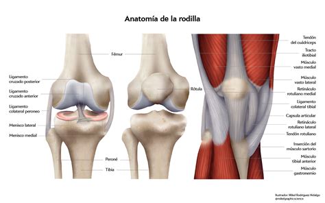 Esquema de la anatomía de la rodilla y cómo se ve una prótesis