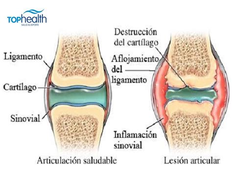 Esquema de la articulación afectada por artrosis con cartílago dañado y osteofitos