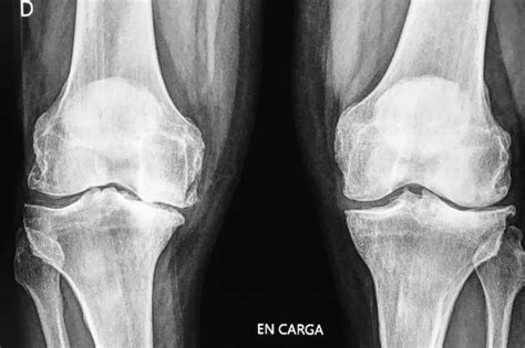 Radiografía de rodilla mostrando signos de artrosis