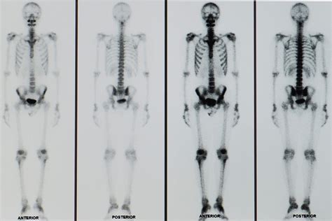 Comparativa de imágenes de gammagrafía ósea y PET scan para detección de metástasis.