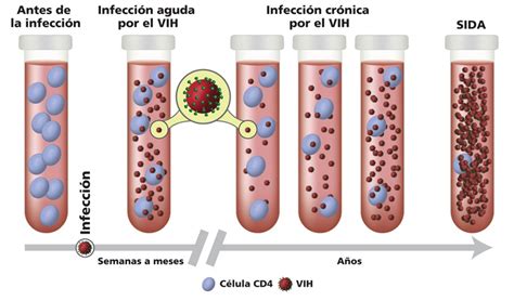 Esquema de las etapas de la infección por VIH y su impacto en el sistema inmunitario