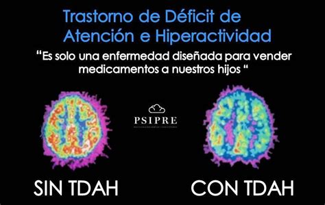 Infografía: Cerebro de una persona con TDAH vs. cerebro neurotípico, destacando diferencias en las áreas de atención y control de impulsos