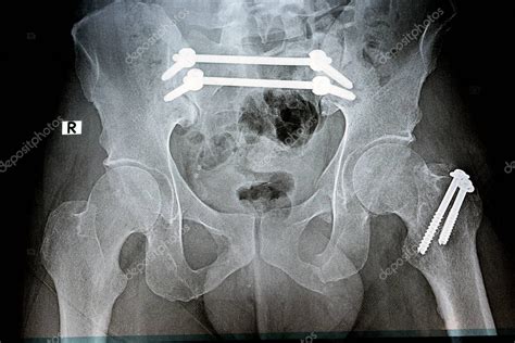 Radiografía de fractura de pelvis