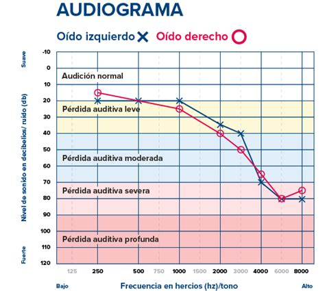 Audiograma mostrando diferentes grados de pérdida auditiva