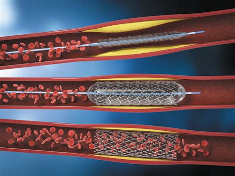 Representación de un stent esofágico colocado