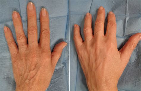 Foto comparativa de manos jóvenes y manos envejecidas con lentigos y venas marcadas