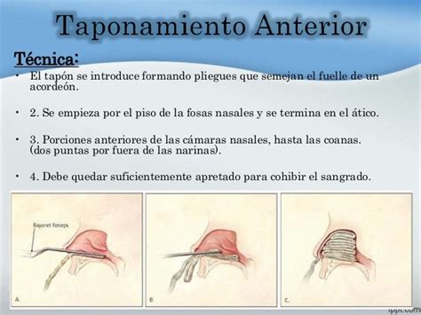 Equipo médico para taponamiento nasal anterior