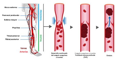 Esquema sobre la formación de trombos en venas profundas y su posible progresión a embolismo pulmonar.