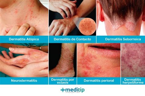 Gráfico mostrando diferentes tipos de dermatitis y problemas comunes de la piel