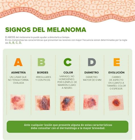 Diagrama de las características del melanoma (asimetría, bordes irregulares, color, diámetro, evolución)