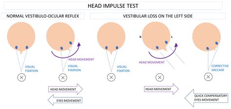 esquema del test del impulso cefálico (Head Impulse Test) mostrando el movimiento rápido de la cabeza y la corrección sacádica
