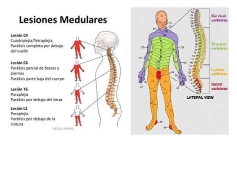 Infografía mostrando los tipos de lesiones de la médula espinal y su impacto en la movilidad del tren inferior