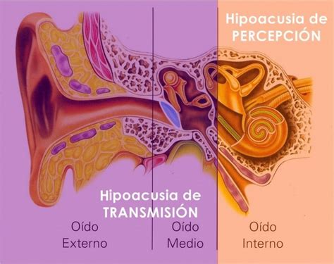 Gráfico mostrando el impacto de la hipoacusia no tratada en diferentes áreas de la vida