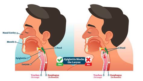 Ilustración mostrando la dificultad para tragar en personas con disfagia.