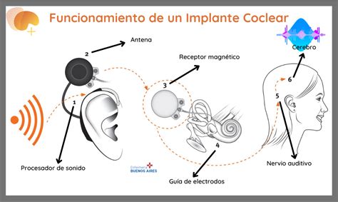 Infografía del funcionamiento de un implante coclear