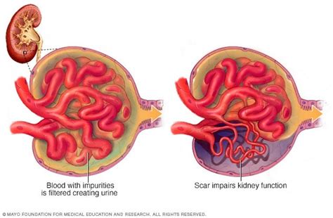 Microfotografía de tejido renal con glomeruloesclerosis