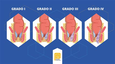 Diagrama mostrando los diferentes grados de hemorroides internas y externas