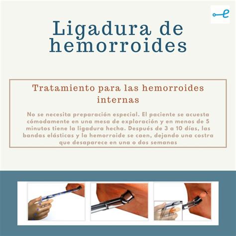 Infografía comparando el procedimiento de ligadura con bandas elásticas y el tratamiento con radiofrecuencia para hemorroides