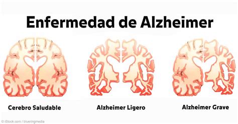 Esquema visual del cerebro humano y las áreas afectadas por el Alzheimer