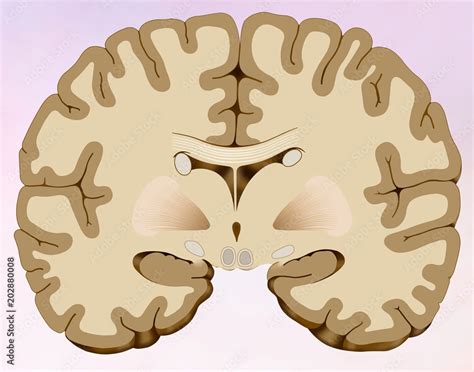 Corte coronal del cerebro de una persona con obesidad (resonancia magnética)