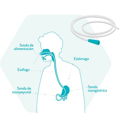 Ilustración de la posición correcta para alimentar a un adulto mayor con sonda nasogástrica