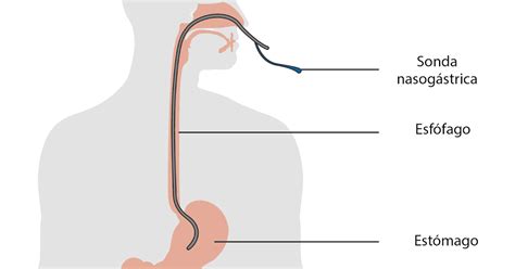 Esquema de cómo limpiar una sonda nasogástrica después de la alimentación