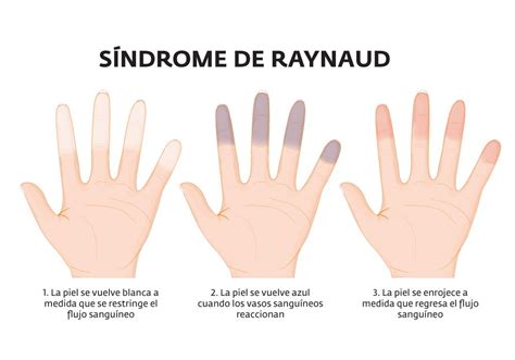 Foto o ilustración de daño tisular severo en dedos afectados por Raynaud