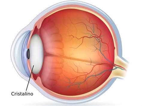 Ilustración del ojo humano mostrando la opacidad del cristalino en una catarata.