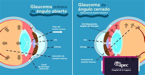 Diagrama que ilustra los dos tipos de glaucoma: de ángulo abierto y de ángulo cerrado.