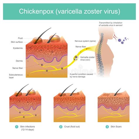 Ilustración del virus de la varicela zoster y su ciclo de infección.
