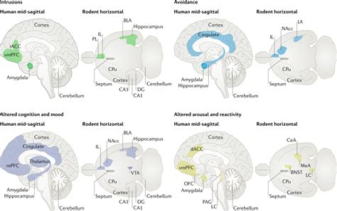 Ilustración de los circuitos cerebrales implicados en la lectura y áreas con anomalías funcionales en dislexia.