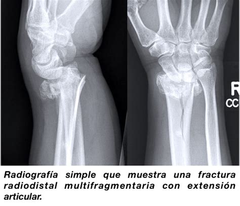 Radiografía de una fractura de Colles en la muñeca