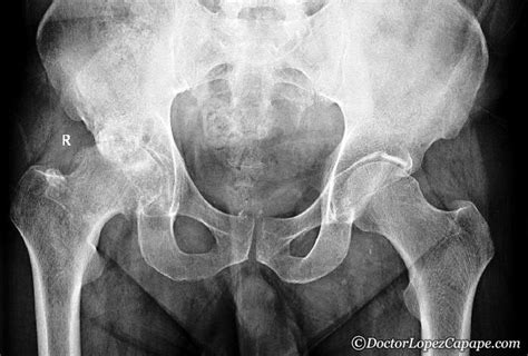 Radiografía de una cadera con coxartrosis