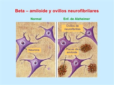 Esquema de las placas amiloides y los ovillos neurofibrilares en el cerebro