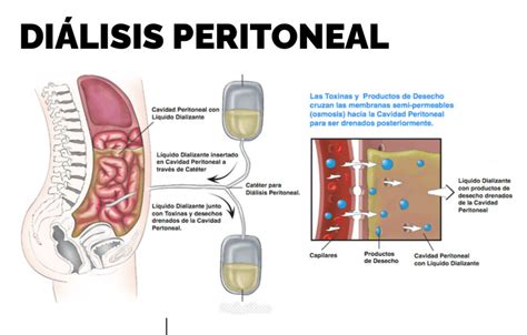 Infografía sobre el funcionamiento de la diálisis peritoneal