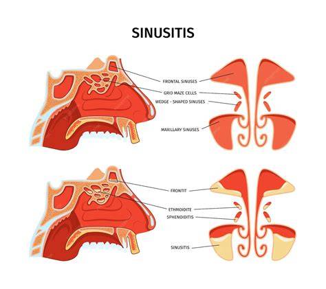 Esquema anatómico que muestra la inflamación de la mucosa nasal y los conductos sinusal