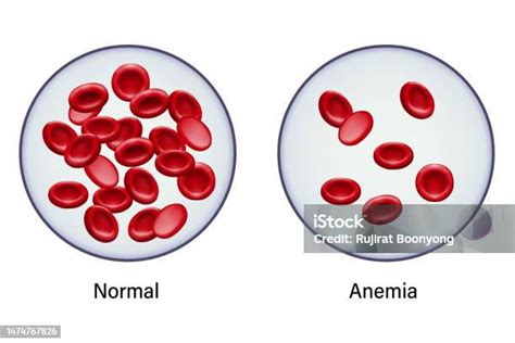 Esquema de glóbulos rojos sanos y anémicos