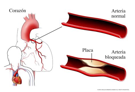 Esquema del corazón con arterias coronarias y una obstrucción por placa