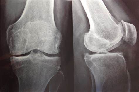 Radiografía de una articulación sana y una con artrosis