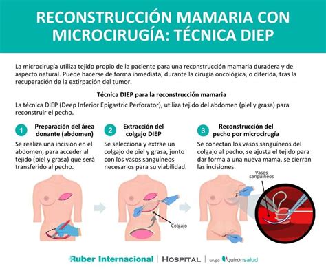 Ilustración de una mastectomía y reconstrucción mamaria