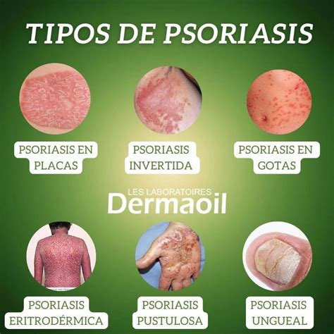 Foto clínica de psoriasis generalizada