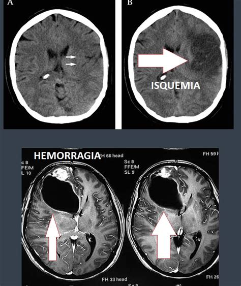 Infarto isquémico vs. Hemorragia intracerebral: diferencias y ubicaciones típicas