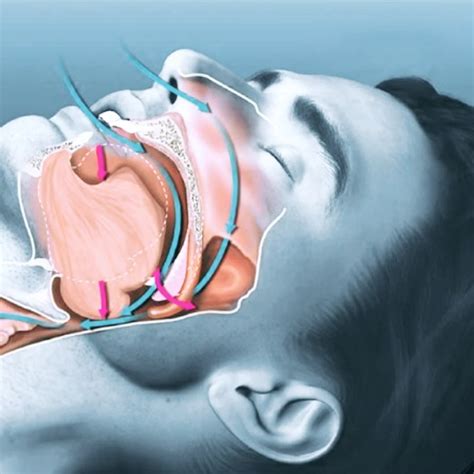 Esquema de las vías respiratorias durante la apnea del sueño