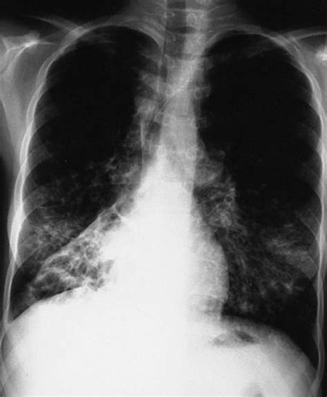 Radiografía de tórax mostrando bronquiectasias típicas en fibrosis quística