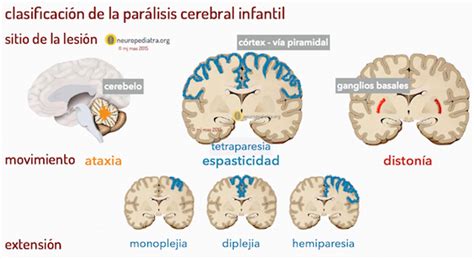 Esquema de las áreas del cerebro afectadas por diferentes tipos de parálisis cerebral