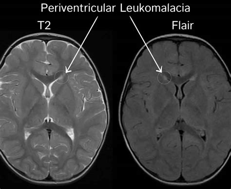 Resonancia magnética de cerebro mostrando leucomalacia periventricular